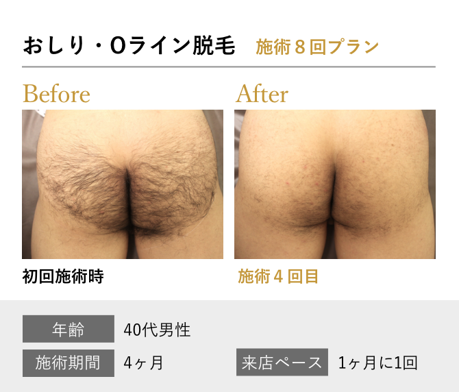 おしり・Oライン脱毛