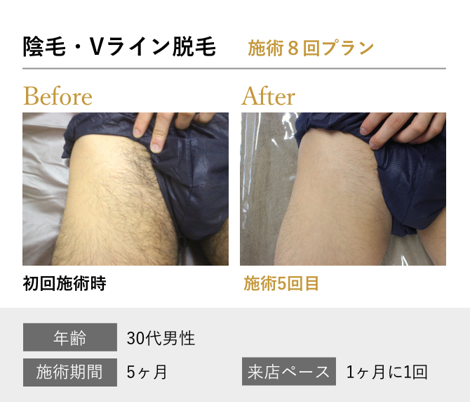 陰毛・Vライン脱毛