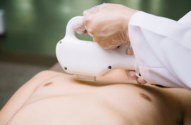 メンズ脱⽑施術