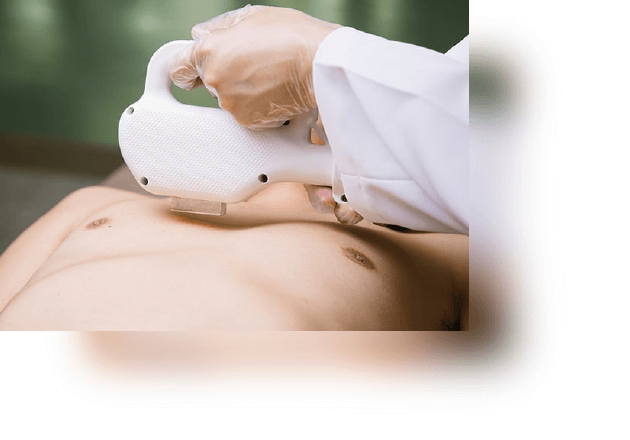 メンズ脱⽑施術